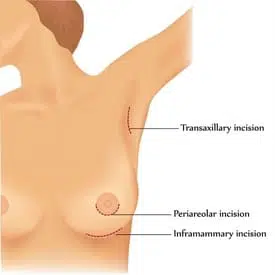 Breast prosthesis in Istanbul - breast augmentation