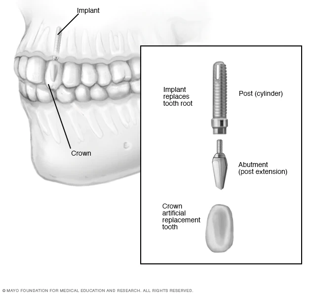 Dental implants in Istanbul