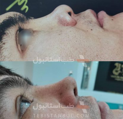 Sample before and after photos of East Asian rhinoplasty in Istanbul