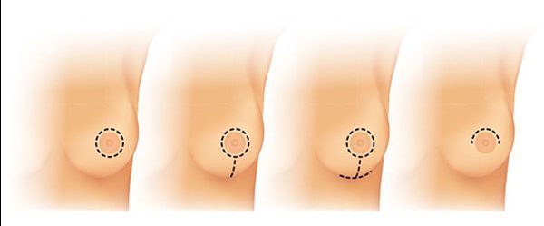Breast lift in Istanbul