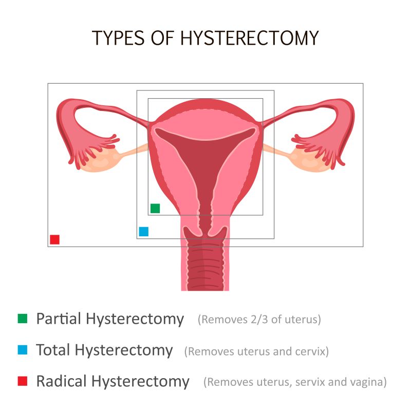 Hysterectomy In Istanbul Purpose Procedure Risks Recovery Treatment In Istanbul