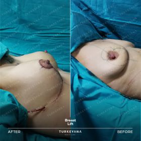 Istanbul Turkeyana plastic surgery
