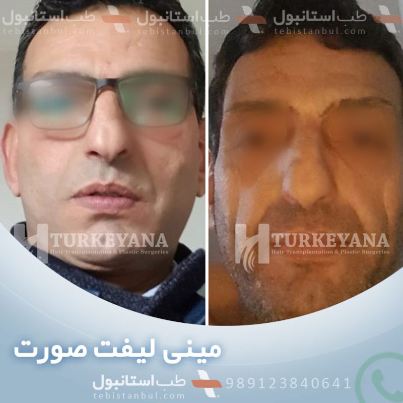 Travel plan for facelift surgery in Istanbul 40 tips Treatment in