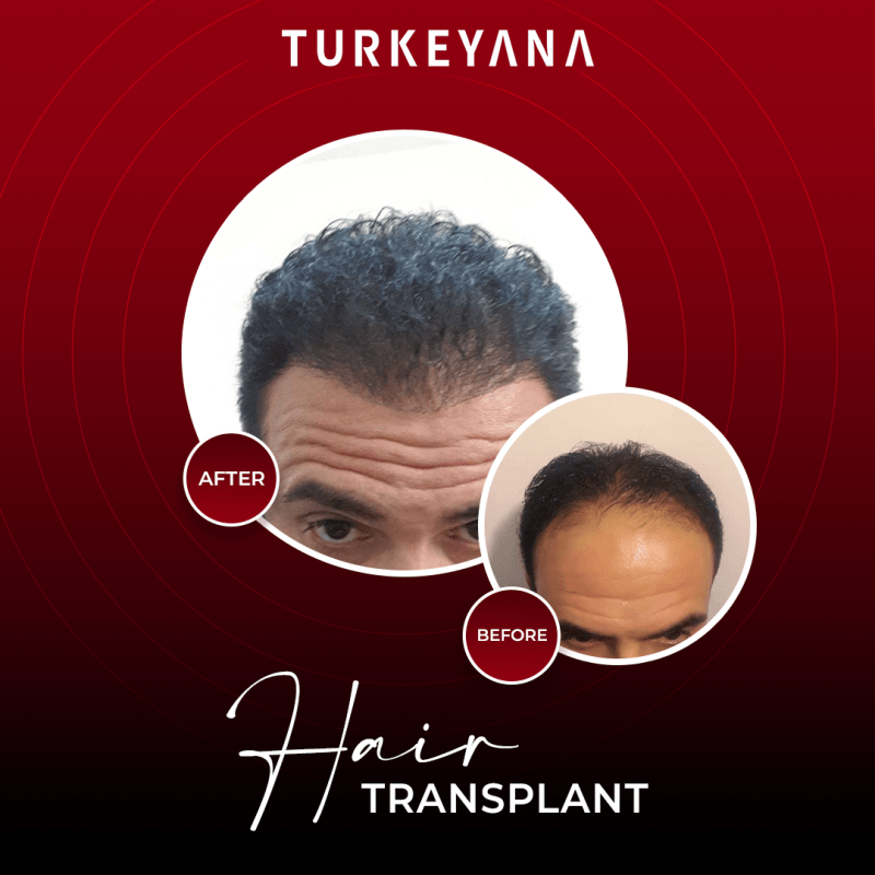 Zidane before and after Hair Transplant in Istanbul Treatment in Istanbul