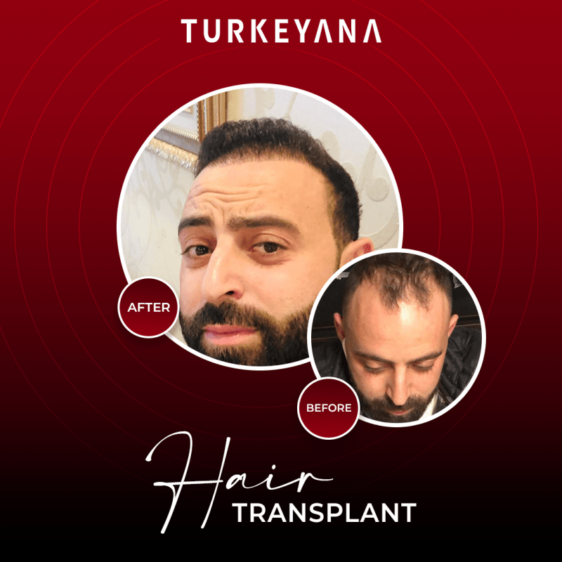 Zidane before and after Hair Transplant in Istanbul Treatment in Istanbul