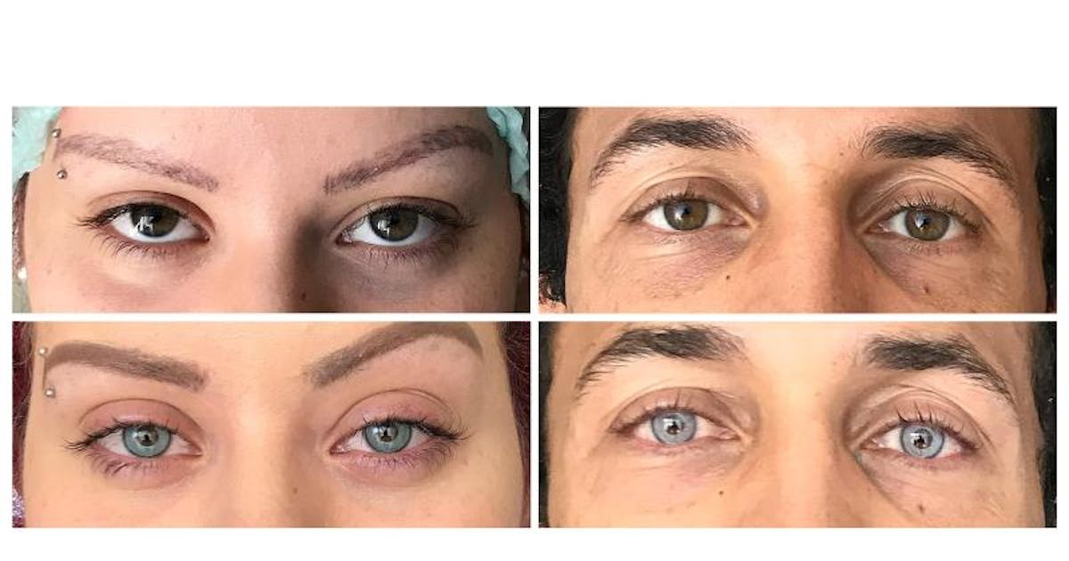Eye color change with laser Permanent Prices 2023 Treatment in
