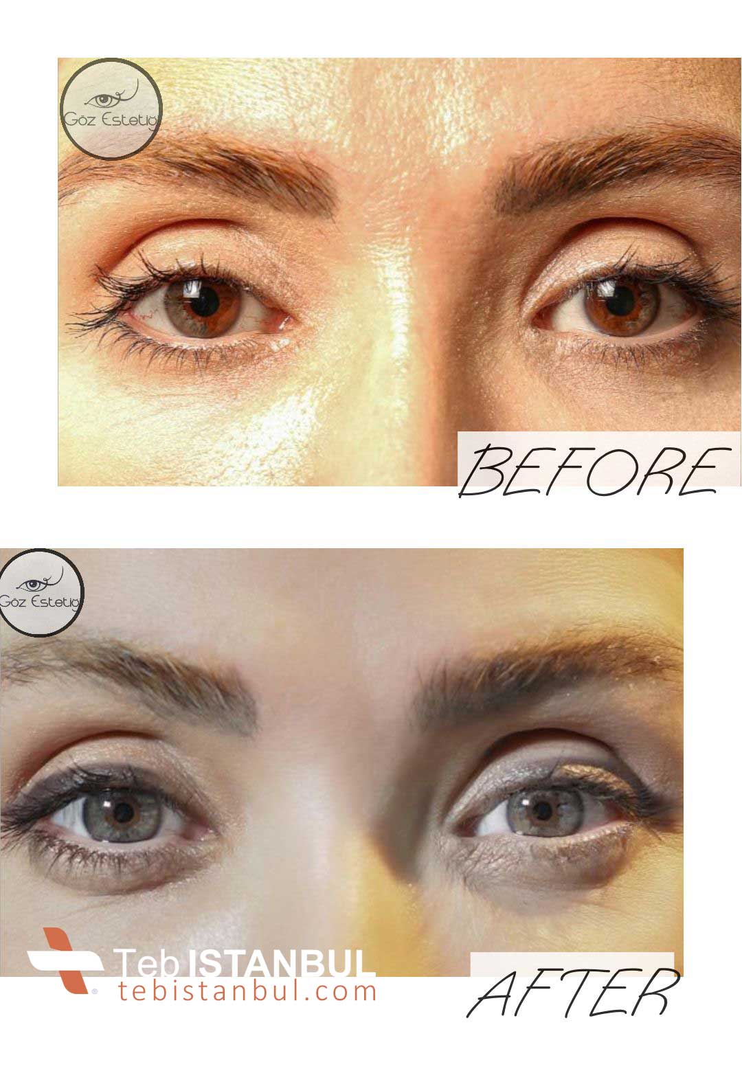 Eye color change with laser Permanent Prices 2023 Treatment in