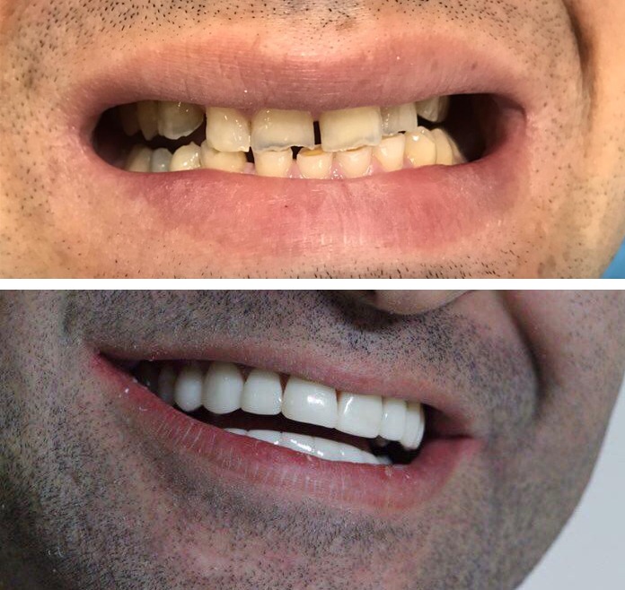 Dental veneers in Türkiye introducing types of dental veneers and prices 2023 Treatment in