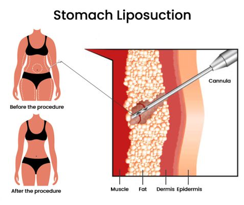 Liposuction in Istanbul - Türkiye