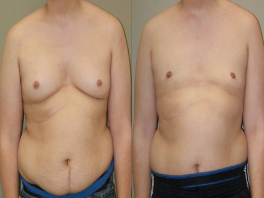 Gynecomastia in Istanbul - Male Breast Reduction