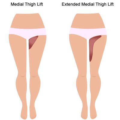 Thigh lift in Istanbul