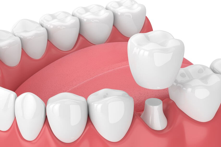 Dental crown in Istanbul Durability & Type Treatment in Istanbul